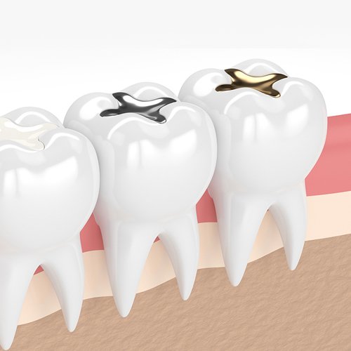 Tooth Filling Specialist